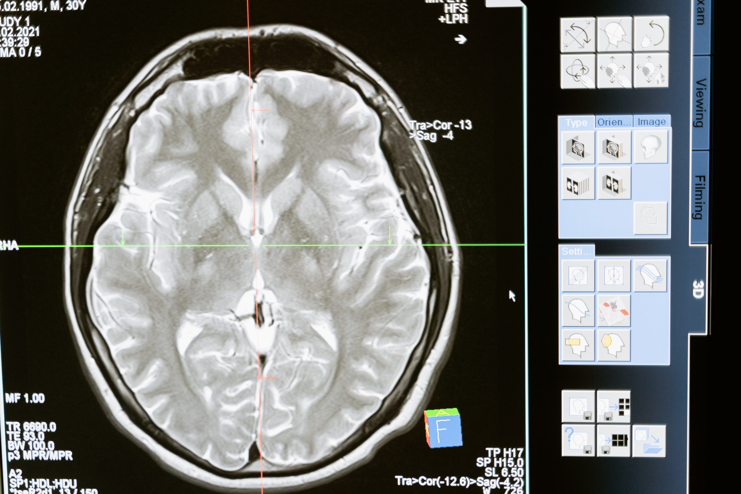 Rising Threat of Brain Stroke: Global Concerns and Preventive Measure